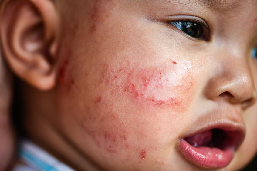 3ed34e83d978fbd83d9c832d67d371f1.jpeg enfant avec de l'eczema